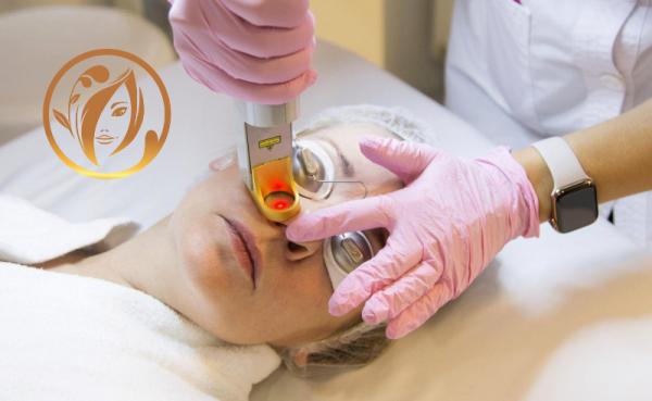 Лазерная эпиляция лица